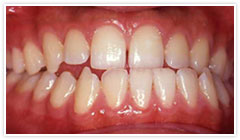 歯槽性下顎前突 治療前イメージ１