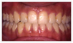 歯槽性下顎前突 治療後イメージ１
