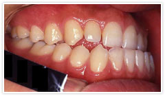 歯槽性下顎前突 治療前イメージ２